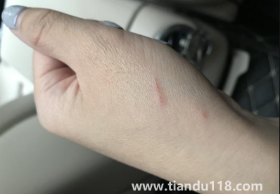 被貓抓了一下輕微破皮要打針嗎(被貓抓傷多少天過危險(xiǎn)期)(圖3) 被貓抓了一下輕微破皮要打針嗎3