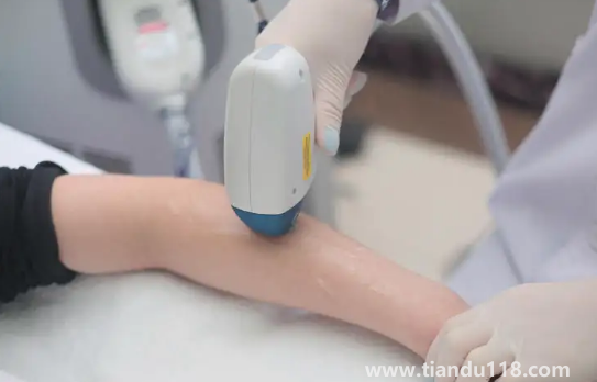 冰點(diǎn)脫毛的具體價(jià)格是多少錢(冰點(diǎn)脫毛一次能維持多久)(圖1) 冰點(diǎn)脫毛的具體價(jià)格是多少錢1